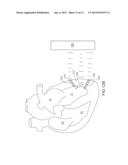 IMPLANTABLE WIRELESS SENSOR SYSTEMS diagram and image