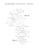 Variable Prosthesis diagram and image