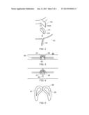 FLUIDISED BED TREATMENT diagram and image