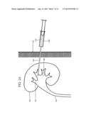 IMMOBILIZING OBJECTS IN THE BODY diagram and image