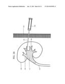 IMMOBILIZING OBJECTS IN THE BODY diagram and image