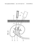 IMMOBILIZING OBJECTS IN THE BODY diagram and image