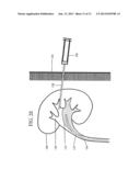 IMMOBILIZING OBJECTS IN THE BODY diagram and image