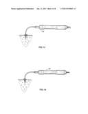 TREATMENT TIP INCISION TEMPLATE diagram and image