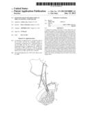 KNOTLESS GRAFT FIXATION USING AN IMPLANT HAVING A POINTED TIP diagram and image