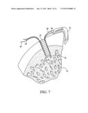 KNOTLESS GRAFT FIXATION USING AN IMPLANT HAVING A POINTED TIP diagram and image