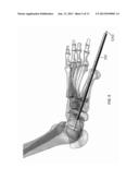 DEVICES AND METHODS FOR BONE FIXATION USING AXIAL IMPLANTS diagram and image