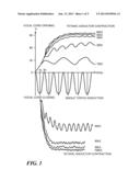 Stimulation System and Method for Voice Lift diagram and image