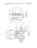 Stimulation System and Method for Voice Lift diagram and image