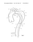 STENT GRAFTS FOR THE THORACIC AORTA diagram and image