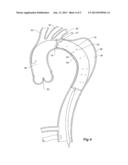STENT GRAFTS FOR THE THORACIC AORTA diagram and image