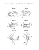 Anchoring Device and System for an Intervertebral Implant, Intervertebral     Implant and Implantation Instrument diagram and image