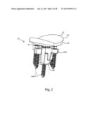 GLENOID VAULT FIXATION diagram and image