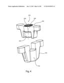 GLENOID VAULT FIXATION diagram and image