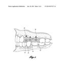 DENTAL IMPLANT REUSABLE BITE REGISTRATION POST diagram and image