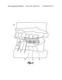 DENTAL IMPLANT REUSABLE BITE REGISTRATION POST diagram and image