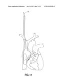 Dual Lumen Cannula diagram and image