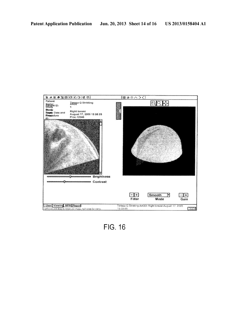 SYSTEM AND METHOD FOR THREE-DIMENSIONAL ULTRASOUND IMAGING - diagram, schematic, and image 15