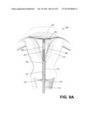 METHODS AND SYSTEMS FOR EVALUATING THE INTEGRITY OF A UTERINE CAVITY diagram and image