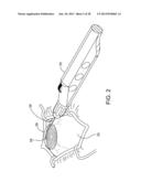 Delivering Ocular Implants Into the Eye diagram and image