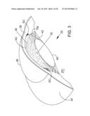 Delivering Ocular Implants Into the Eye diagram and image