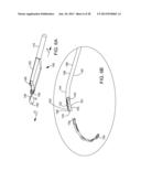 Delivering Ocular Implants Into the Eye diagram and image