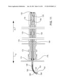 Delivering Ocular Implants Into the Eye diagram and image