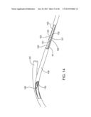 Delivering Ocular Implants Into the Eye diagram and image