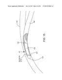 Delivering Ocular Implants Into the Eye diagram and image