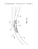 Delivering Ocular Implants Into the Eye diagram and image