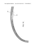 Delivering Ocular Implants Into the Eye diagram and image