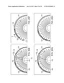 Delivering Ocular Implants Into the Eye diagram and image