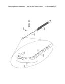 Delivering Ocular Implants Into the Eye diagram and image