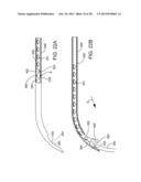 Delivering Ocular Implants Into the Eye diagram and image