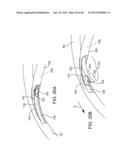 Delivering Ocular Implants Into the Eye diagram and image