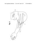 DIALYSIS NEEDLE SYSTEM diagram and image