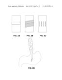 METHOD AND DEVICE OF DETECTING AND/OR BLOCKING REFLUX diagram and image