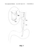 METHOD AND DEVICE OF DETECTING AND/OR BLOCKING REFLUX diagram and image