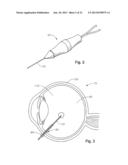 VITRECTOMY PROBE WITH ADJUSTABLE CUTTER PORT SIZE diagram and image