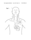 Implantable Device For Evaluating Autonomic Cardiovascular Drive In A     Patient Suffering From Chronic Cardiac Dysfunction diagram and image