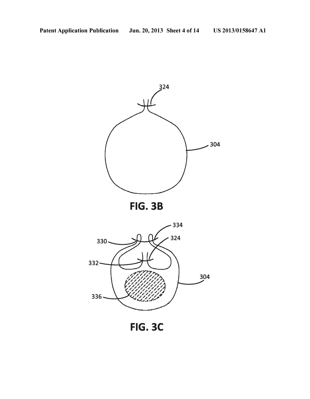 APPOSITION FIBER FOR USE IN ENDOLUMINAL DEPLOYMENT OF EXPANDABLE IMPLANTS - diagram, schematic, and image 05