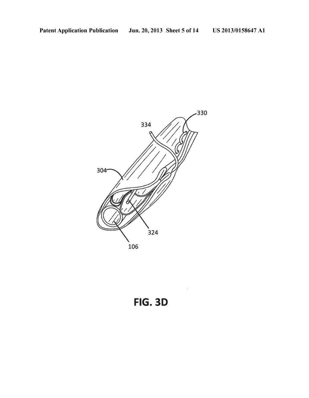 APPOSITION FIBER FOR USE IN ENDOLUMINAL DEPLOYMENT OF EXPANDABLE IMPLANTS - diagram, schematic, and image 06