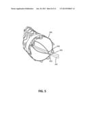 APPOSITION FIBER FOR USE IN ENDOLUMINAL DEPLOYMENT OF EXPANDABLE IMPLANTS diagram and image