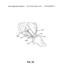 APPOSITION FIBER FOR USE IN ENDOLUMINAL DEPLOYMENT OF EXPANDABLE IMPLANTS diagram and image