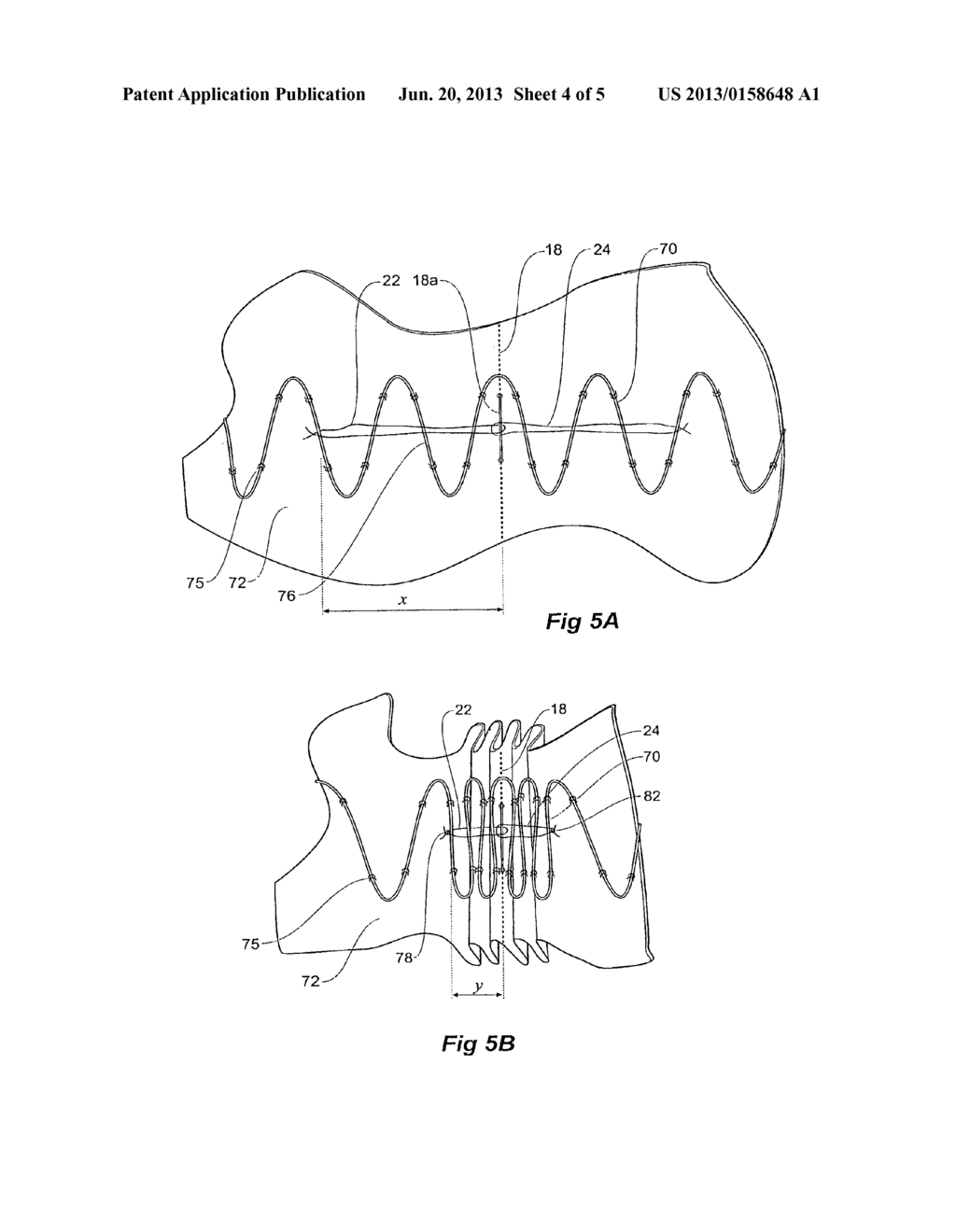 STENT GRAFTS FOR THE THORACIC AORTA - diagram, schematic, and image 05