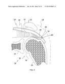 IMPLANTABLE TENDON PROTECTION SYSTEMS AND RELATED KITS AND METHODS diagram and image