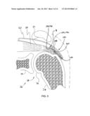 IMPLANTABLE TENDON PROTECTION SYSTEMS AND RELATED KITS AND METHODS diagram and image