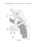 IMPLANTABLE TENDON PROTECTION SYSTEMS AND RELATED KITS AND METHODS diagram and image