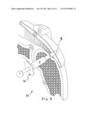 IMPLANTABLE TENDON PROTECTION SYSTEMS AND RELATED KITS AND METHODS diagram and image