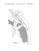 IMPLANTABLE TENDON PROTECTION SYSTEMS AND RELATED KITS AND METHODS diagram and image